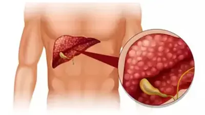 5 أعراض للإصابة بسرطان المرارة النادر، احذر منها