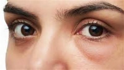 حلول منزلية سريعة وفعالة للتخلص من انتفاخ العينين بعد البكاء