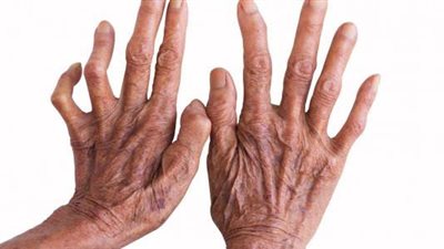 الصحة تطلق حملة لإزالة الوصمة عن مرضى الجذام ودمجهم في المجتمع دون عزل