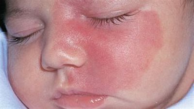 أعراض الحمى الوردية وأسبابها وطرق علاجها 