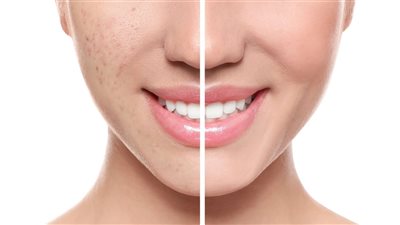 أفضل وصفات طبيعية، لعلاج آثار حبوب الوجه
