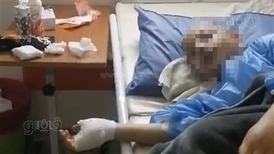 الصور الأولى لطفلي التعذيب على يد زوجة أبيهم بالإسكندرية 