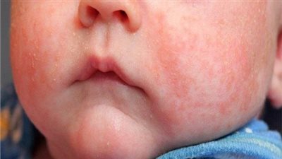 احذري: التعامل الخاطئ مع حمو النيل يزيد من ظهوره عند الأطفال 