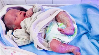 نجاح حالة ولادة قيصرية لطفل شمعي بمستشفى سنورس المركزي بالفيوم