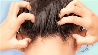 وصفة طبيعية وسهلة تخلصك من قشرة الشعر 