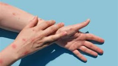 أول تعليق من التعليم على انتشار فيروس HFMD في المدارس