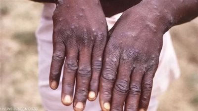 بعد تحذيرات من تفشي الفيروس عالميًا، وفاة أول حالة مصابة بجدري القرود في غانا