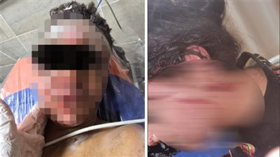 حروق طالت الجميع، الحالة الصحية لمصابي انفجار أسطوانة بوتاجاز داخل مطعم بسوهاج (صور)