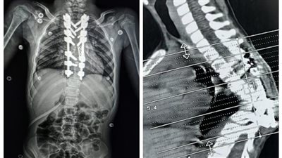 فريق طبي بجامعة أسيوط ينجح في إنقاذ حياة طفلة من تشوه خطير بالعمود الفقري