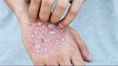 أسباب مرض الصدفية وأعراضه وطرق الوقاية منه