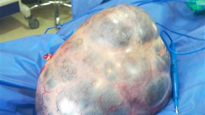 استئصال ورم وزنه 7 كيلو جرامات من بطن مريضة بمستشفى أبشواى بالفيوم