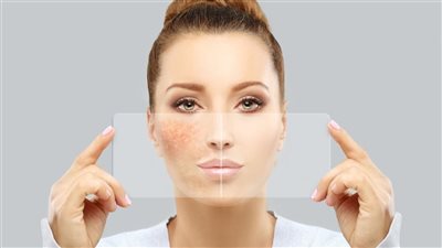 علاج تصبغات حروق الشمس بالبشرة بمواد طبيعية 