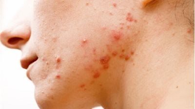 قناع طبيعي ينقي البشرة ويحمي من حب الشباب 