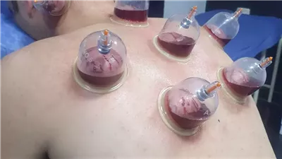 وردت في السنة النبوية، 18 فائدة صحية للحجامة وهذا ما تفعله لآلام الظهر والرقبة