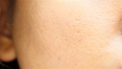 قناع طبيعي يخلصك من البثور البيضاء بالبشرة 