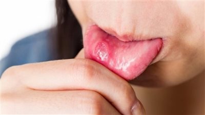 منها العدوى والطقس البارد، أسباب ومحفزات ظهور قرحة الفم 
