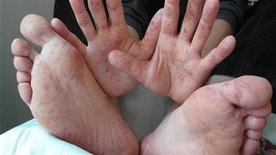 أعراض مرض HFMD عند الأطفال (انفوجراف)