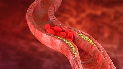 نصائح لخفض الكوليسترول المرتفع بطرق طبيعية 