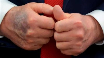 بسبب قصور وريدي مزمن، صور حديثة تكشف كدمة كبيرة في يد ترامب