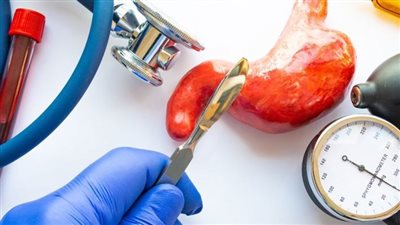 ما السن المناسب لعمليات تكميم المعدة؟ استشاري باطنة يجيب