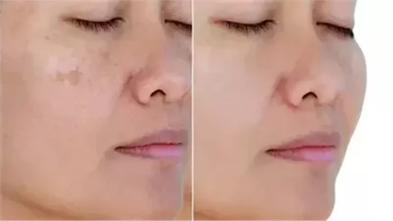 البقع الداكنة 