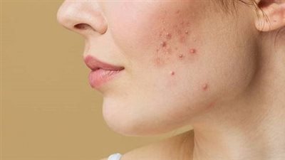 نصائح مهمة تساعدك فى تجنب ظهور الندبات بالبشرة 