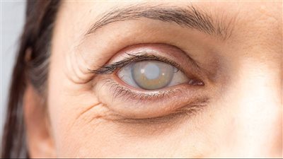 أعراض المياه البيضاء على العين ومخاطر الإصابة بها