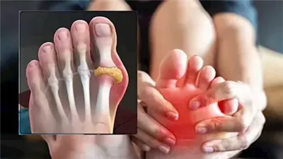 ثورة طبية في علاج تعافي كسور العظام باستخدام دواء عصبي