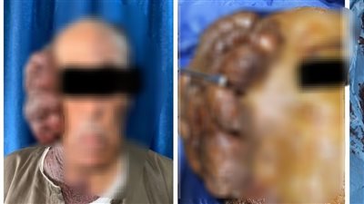 فريق طبي بجامعة أسيوط ينجح في استئصال ورم نادر وزنه 2 كيلو من وجه مسن (صور) 