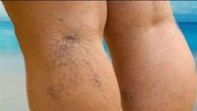 أسباب دوالي الساقين ومخاطر الإصابة بها