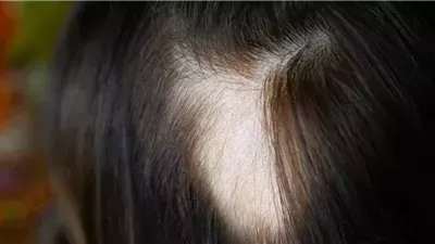 أعراض الثعلبة وأسباب الإصابة بها وطرق العلاج 