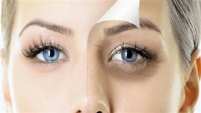 علاج فعال يخلصك من الهالات السوداء حفاظا على جمالك 