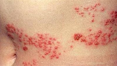 أسباب الحزام الناري وأعراضه ومخاطر الإصابة به