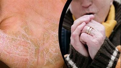 طبيبة مناعة روسية تُحذر العالم من مرض غير عادي 