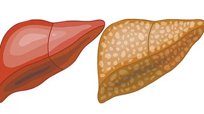 ارتفاع حالات الكبد الدهني في الأطفال، أستاذة بالقومي للبحوث تحذر