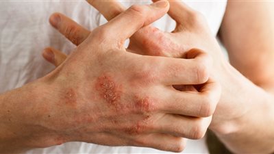 أسباب الإصابة بالإكزيما في موسم الشتاء 