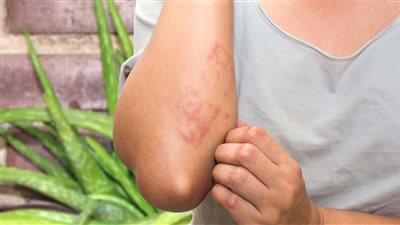 علاج الأكزيما.. 6 نصائح للمرضى لمنع التهيجات الجلدية