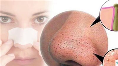 علاج الرؤوس السوداء، بالمواد الطبيعية في أسرع وقت