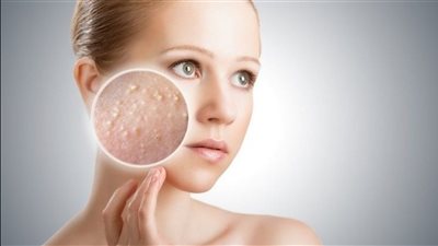 نصائح مهمة تجنبك ظهور البثور البيضاء بالبشرة 