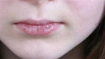 أسباب لون الشفاه الأبيض والباهت عند الأطفال 