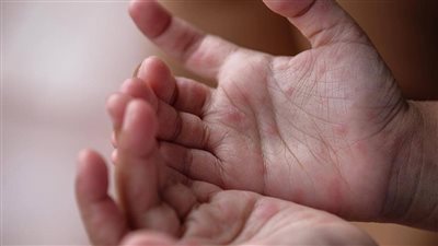 بعد إصابة 4 طلاب بمدرسة في المريوطية، طرق الوقاية من مرض اليد والقدم والفم (HFMD)