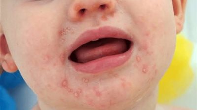 الصحة تكشف حقيقة شائعة عدوى فيروس HFMD بين الأطفال
