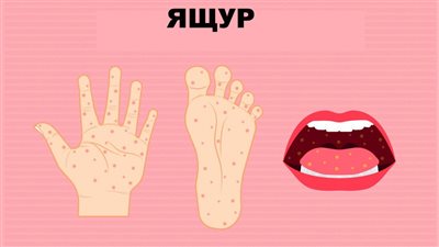 بعد إصابة 4 طلاب بمدرسة المريوطية، المراحل الأربع لتطور مرض اليد والقدم والفم (HFMD)