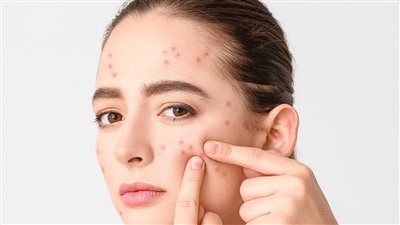 روتين كامل للعناية بالبشرة المعرضة لحب الشباب