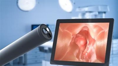 بحث طبي بقصر العيني يكشف التحورات الجينية لسرطان القولون بتقنية حديثة