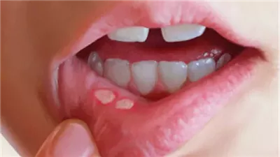 تحذير طبي من انتشار الهربس بين الرضع وهذه طرق الوقاية 