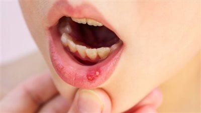 اعرفى أفضل تغذية لطفلك المصاب بالهربس