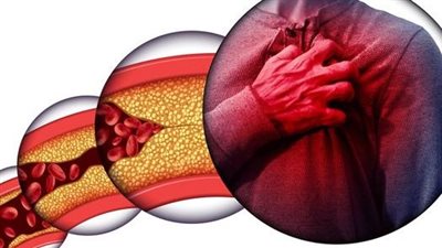 أطعمة طبيعية تساعد على خفض الكوليسترول في 3 أشهر