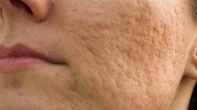 أسباب الحفر بالبشرة وطرق علاجها والوقاية منها 