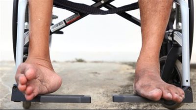 فى اليوم العالمي، ماهو شلل الأطفال وأسبابه وأعراضه وطرق الوقاية منه